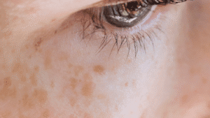 Read more about the article Pigmentation Doctor in Singapore: Navigating the Complexities of Skin Treatment