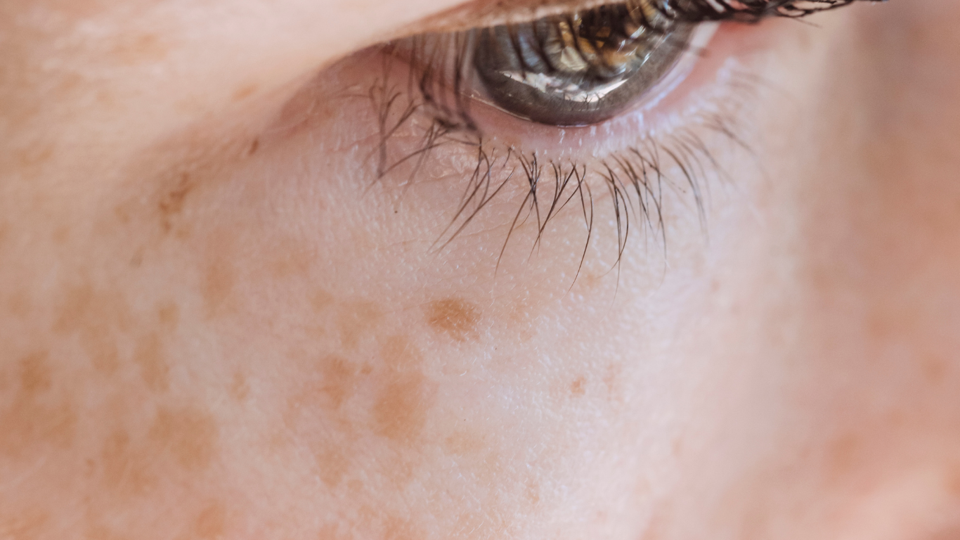 Pigmentation Doctor in Singapore