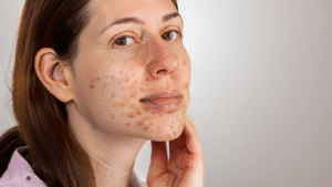 Read more about the article Sylfirm: A Comprehensive Look at How Sylfirm X Helps Treat Rosacea in Singapore