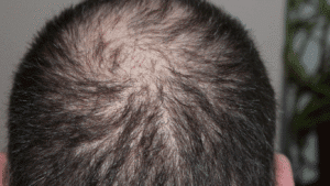Read more about the article Hair Transplant Singapore: Can You Wear a Hat After the Procedure?